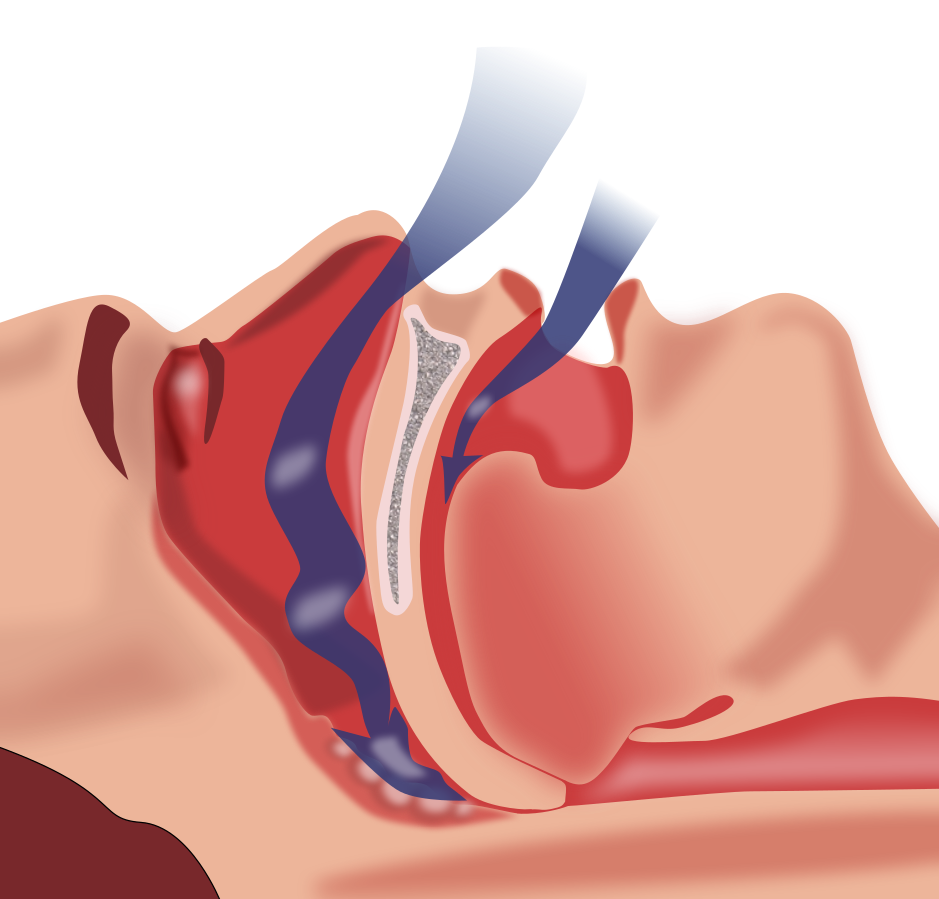 Understanding Obstructive Sleep Apnea with Prof. Dr Syed A Husain