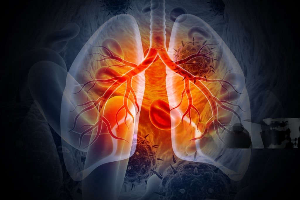 Lung Cancer: Early Detection and Treatment Options Offered by Pulmonologists