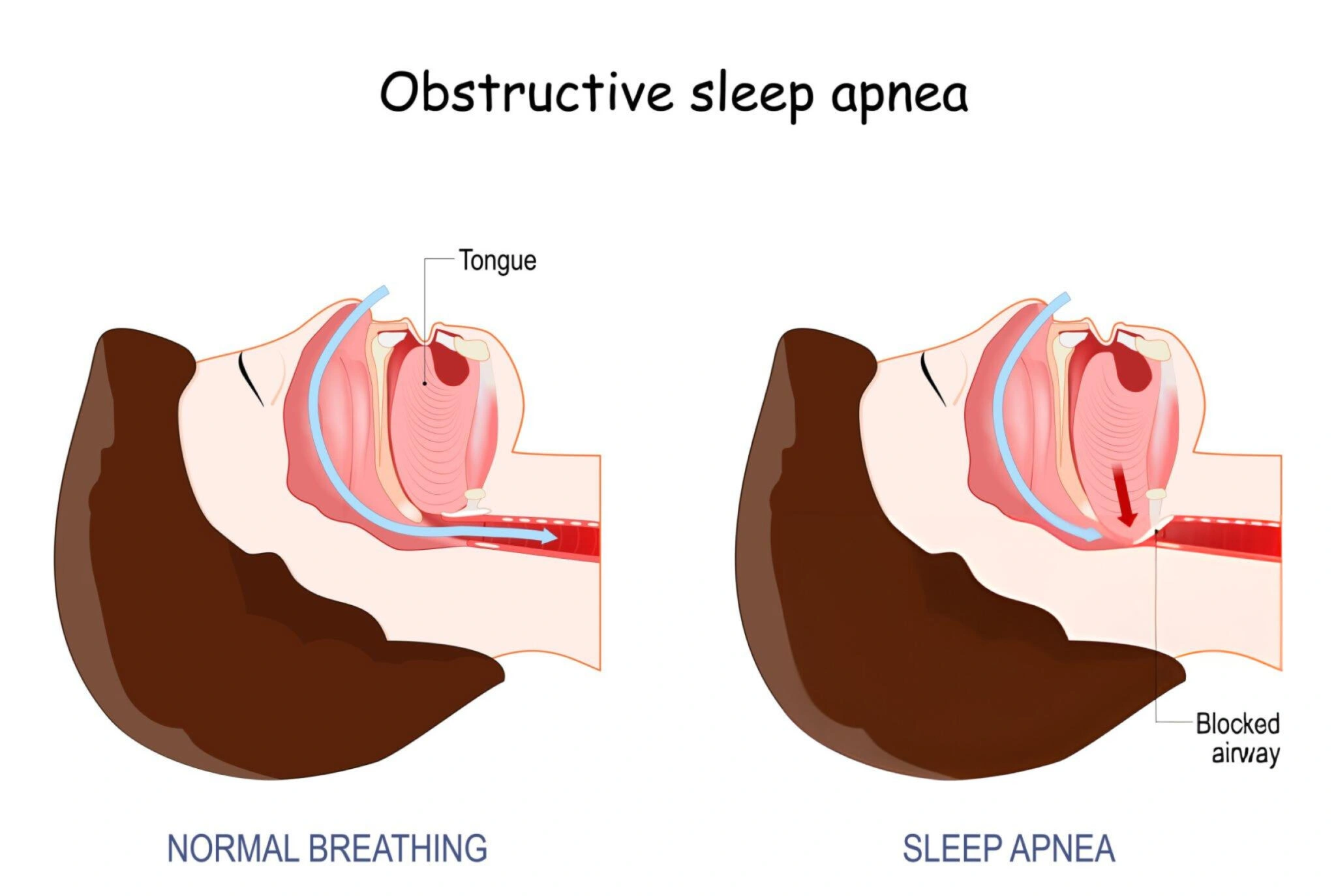 Some Risk Factors for Obstructive Sleep Apnea?
