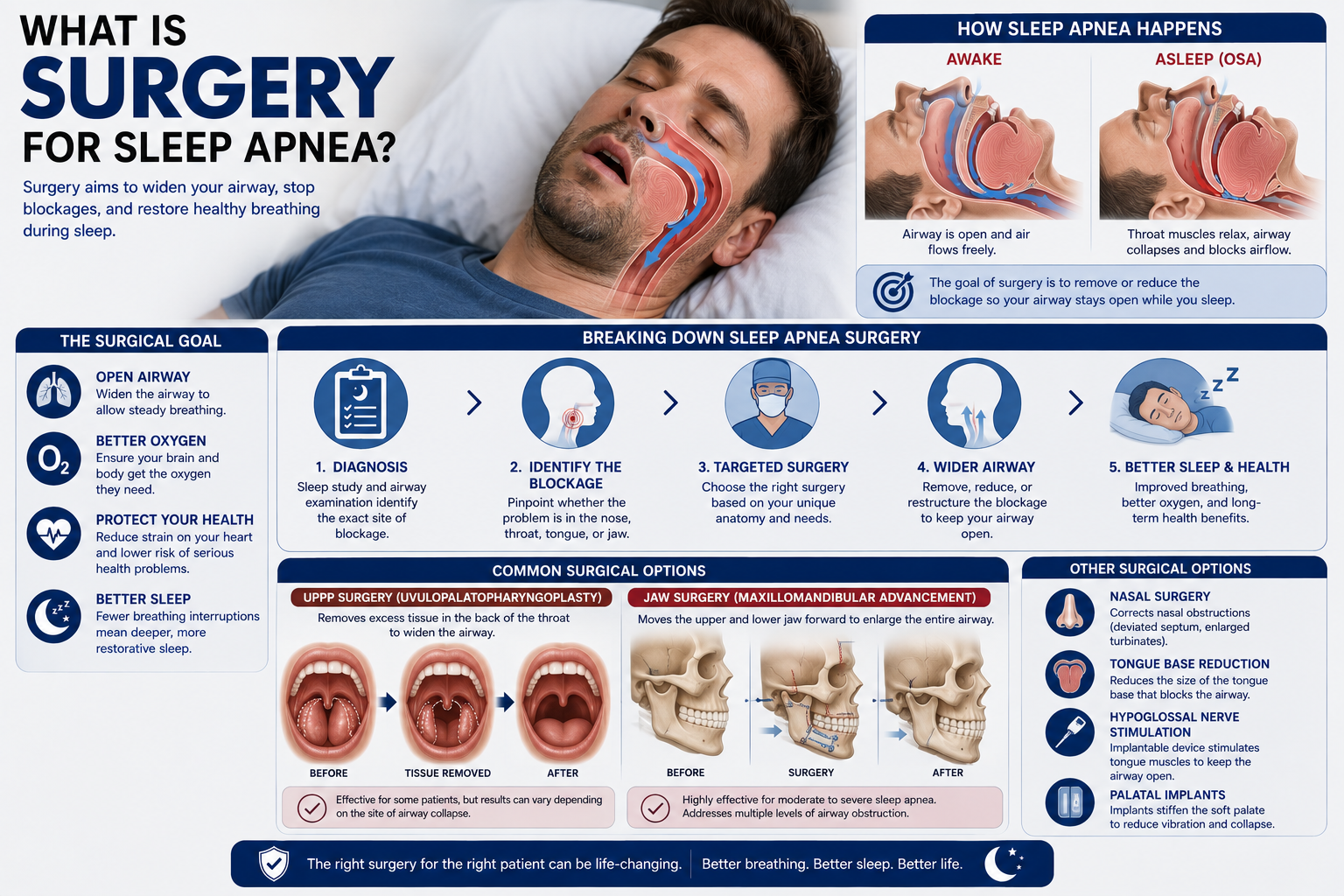 Is Surgery for Sleep Apnea Right for You? Key Facts & Options