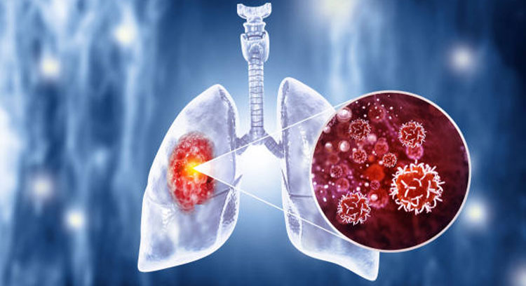 Best lung cancer treatment in UAE