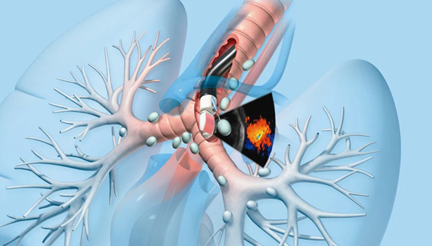 Endobronchial Ultrasound (EBUS) & ROSE