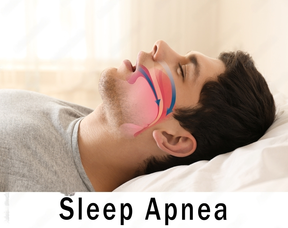 Understanding Obstructive Sleep Apnea: Diagnosis and Treatment