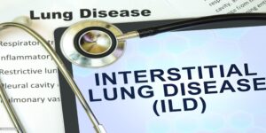 interstitial lung disease to prof. dr. Syed Arshad Husain