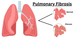 7 Things About Pulmonary Fibrosis