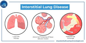 Interstitial Lung Disease By Dr Syed Arshad Husain