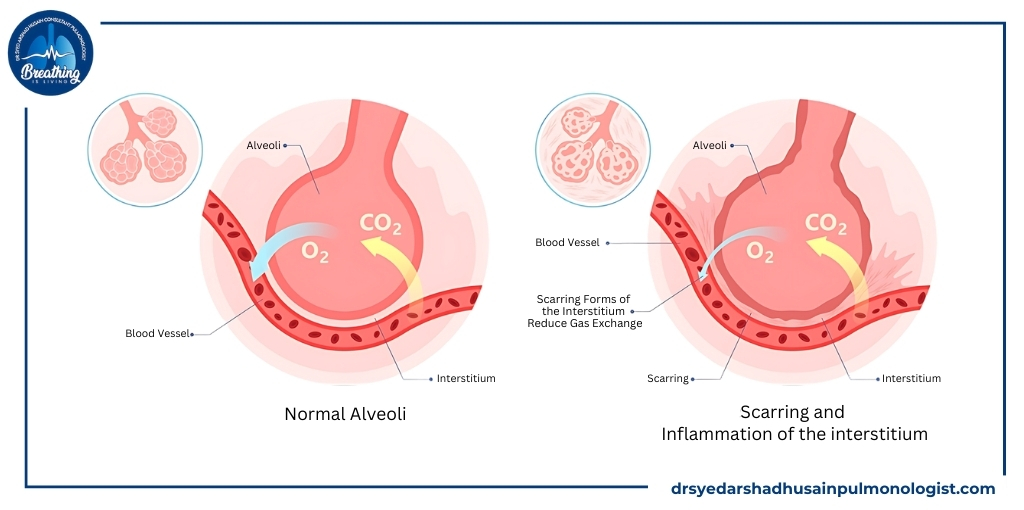 Lung Fibrosis By Dr Syed Arshad Husain