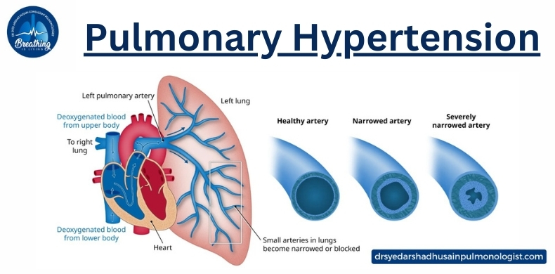 pulmonary hypertension