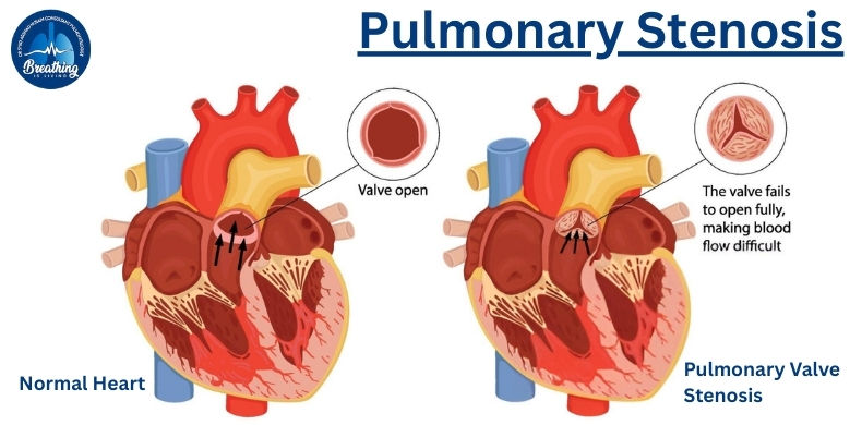 pulmonary stenosis explaination by dr syed arshad husain