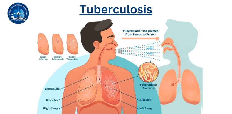 tuberculosis diagram by dr syed arshad husain